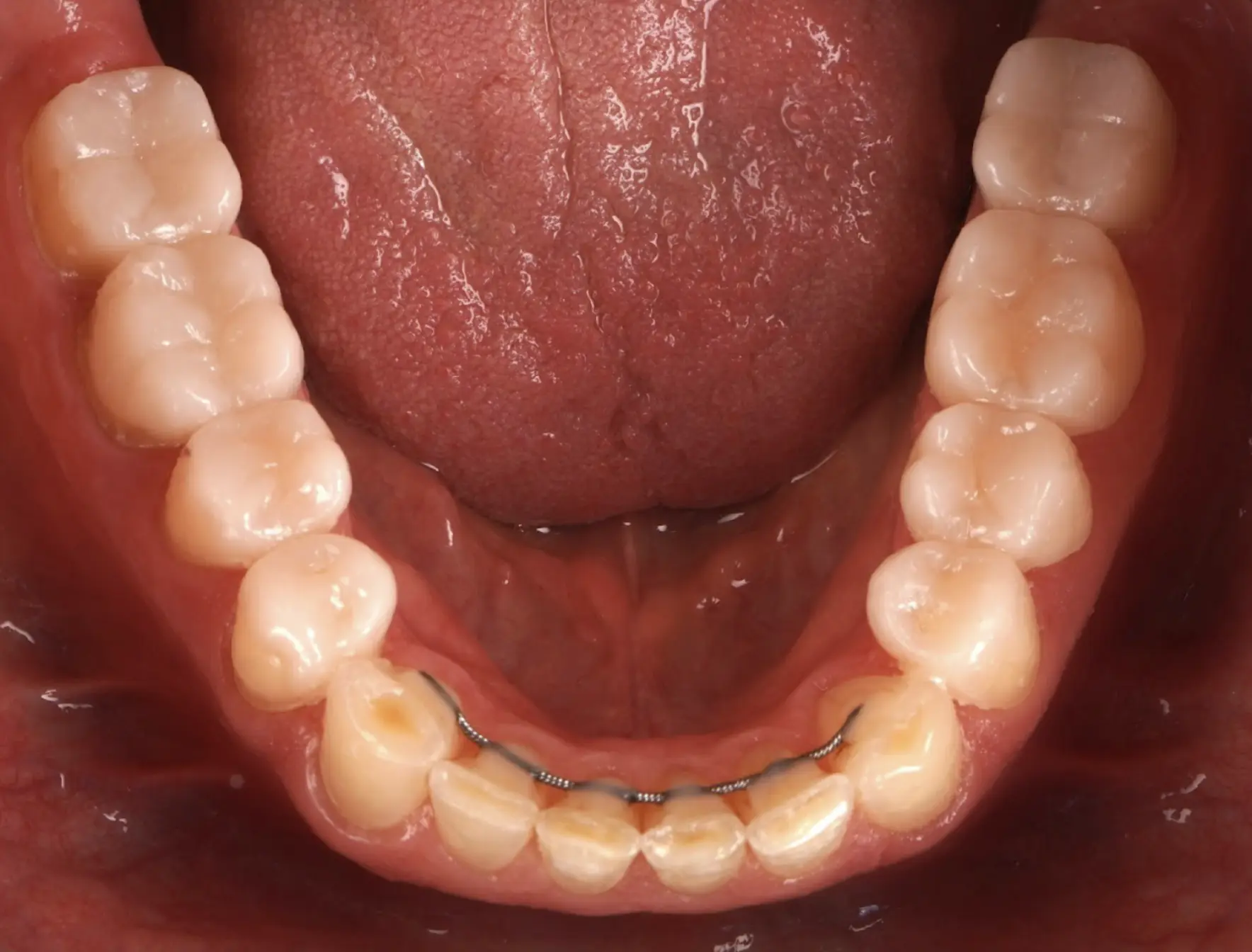Mock-up of posterior teeth