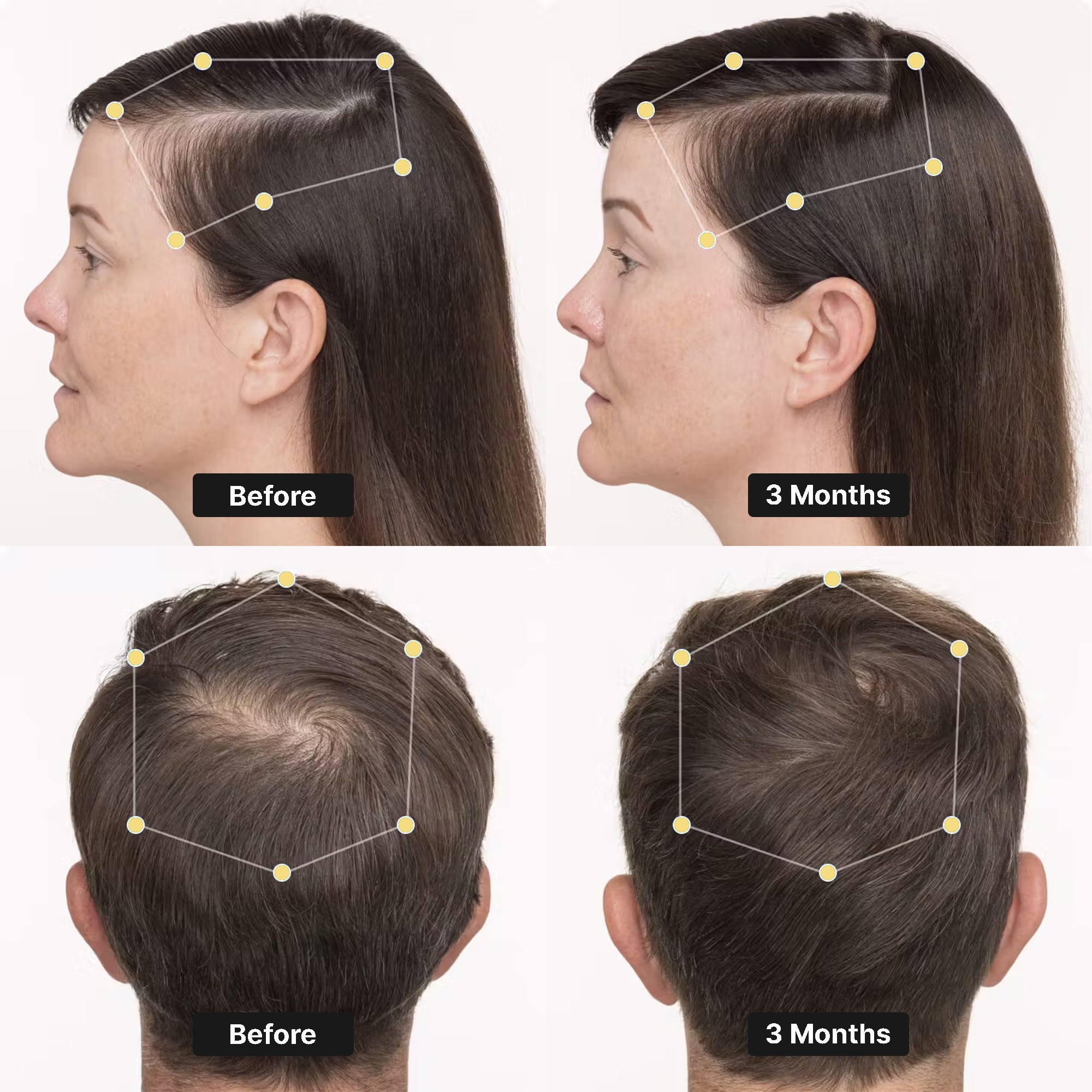 Nutrafol hair restoration treatment