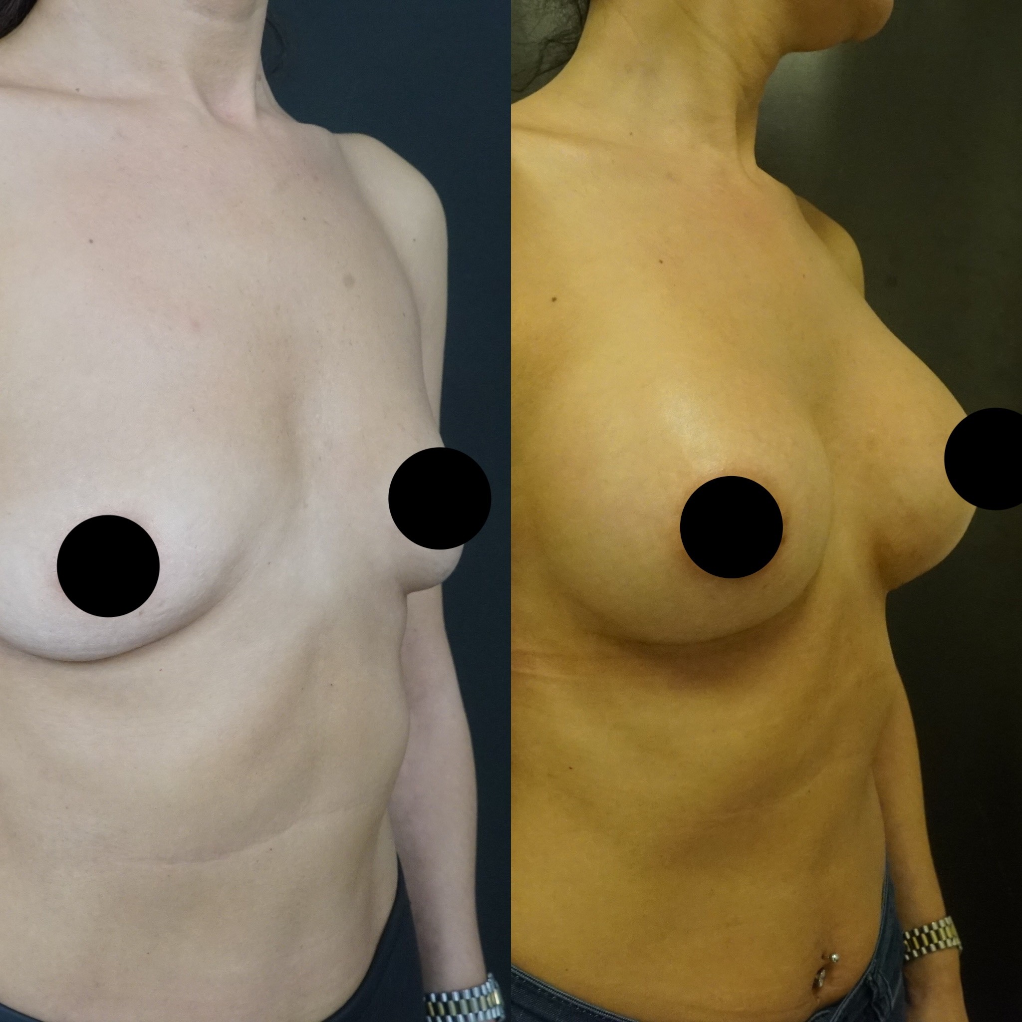 breast augmentation 4 months result right oblique view