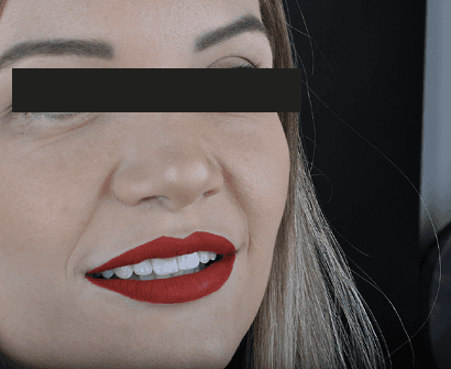 Imagem clínica do sorriso de paciente adulta, com identidade preservada para fins ilustrativos