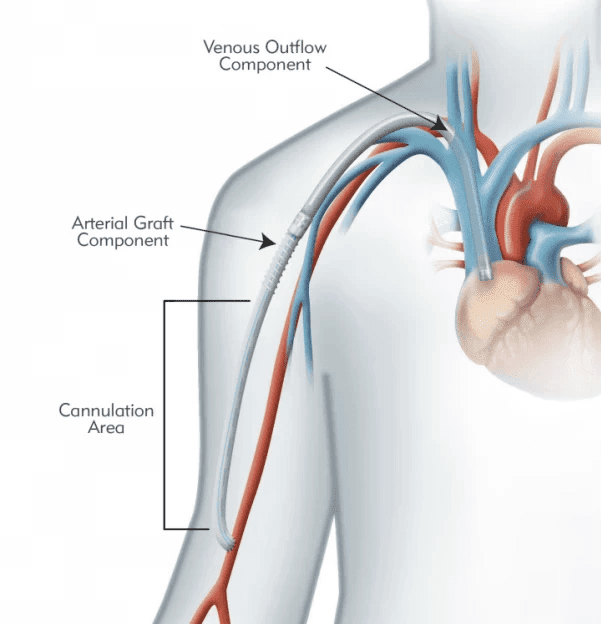 HeRO 히어로 수술 - 투석혈관 조성, 하이브리드 수술