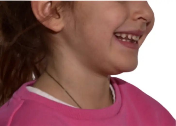 Before and after comparison: more relaxed smile, less muscle tension after “unblocking” the deep bite and “releasing” the lower jaw forward. Profile changes, better lip competence.