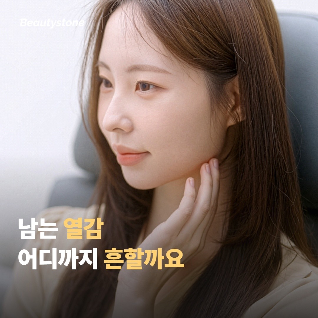 인모드 FX 후 남는 열감, 어디까지가 흔한 반응일까요