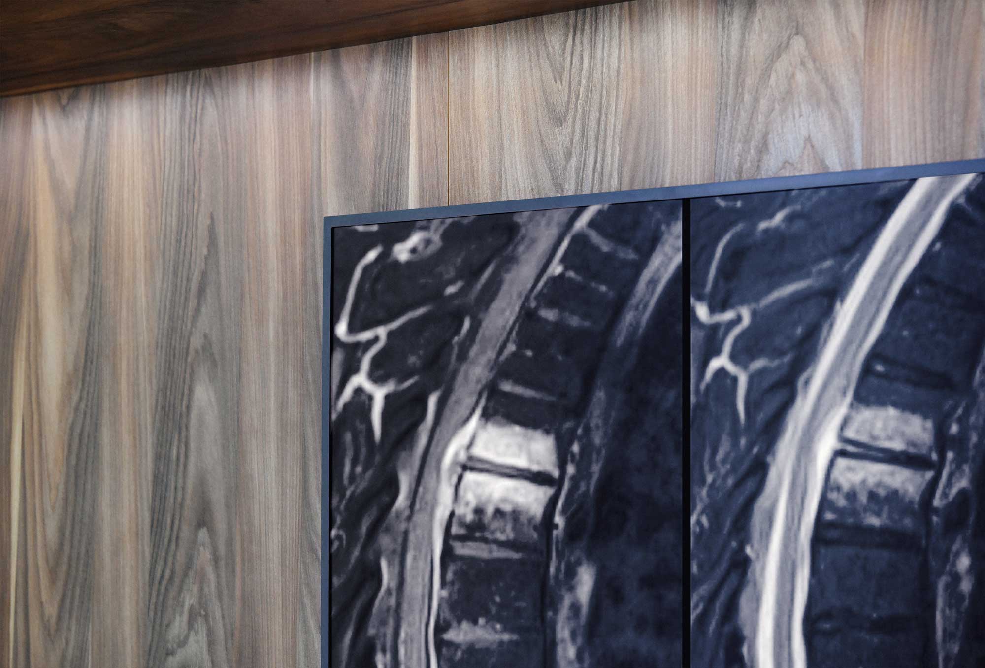 Entzündung der Wirbelsäule / Spondylodiszitis