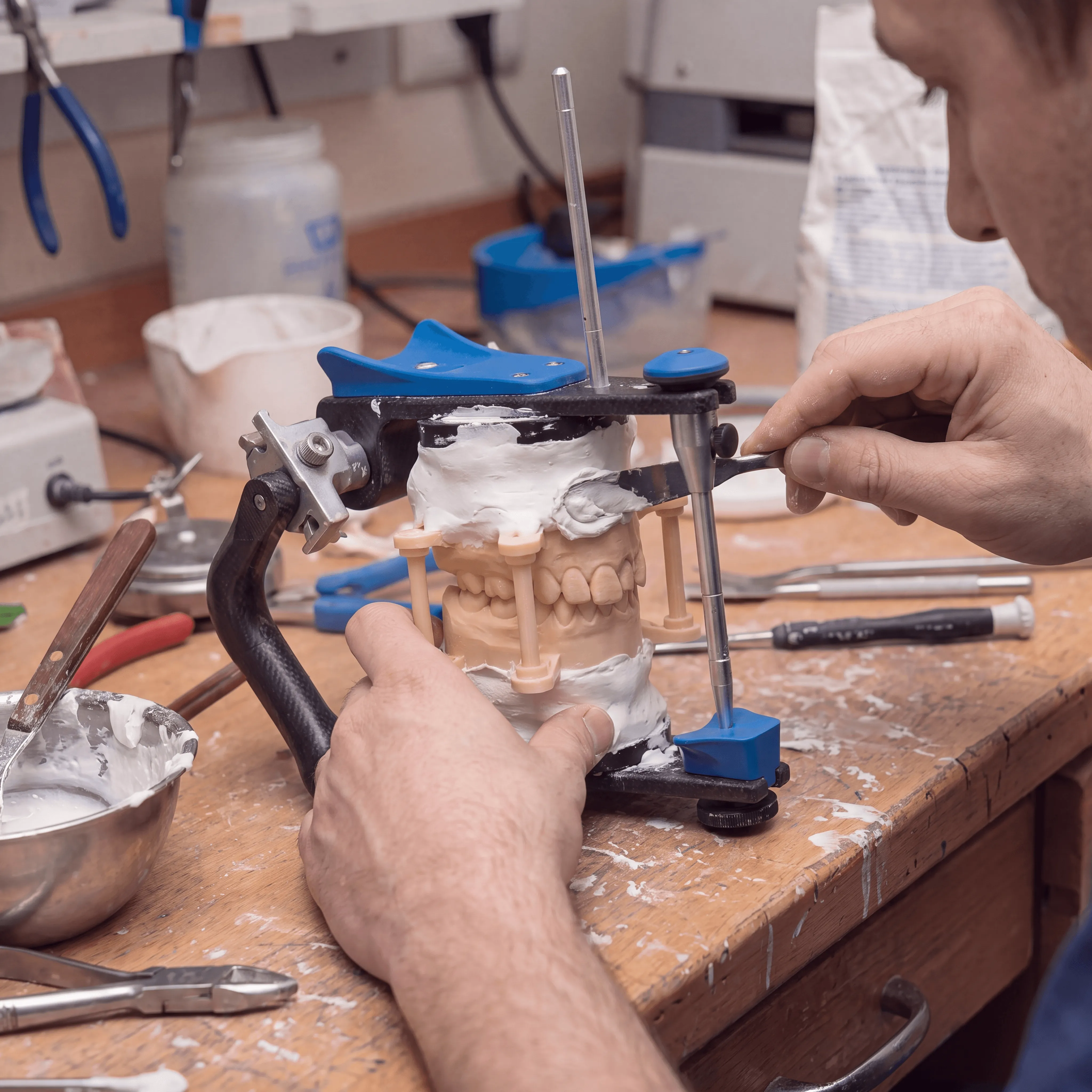 Traditional plaster mounting on an articulator — manual, variable