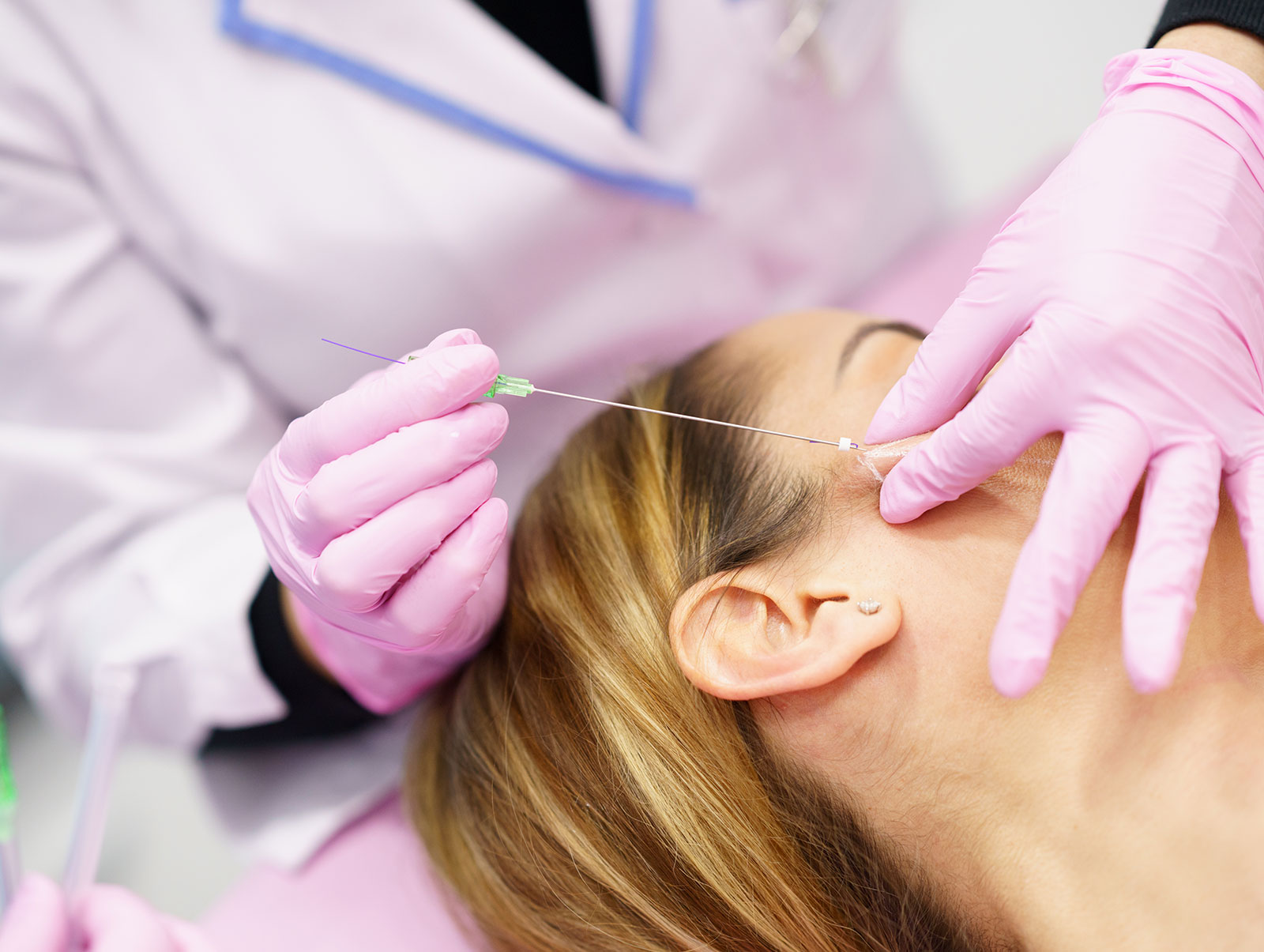 A professional performing a PDO thread lift on a woman's face, inserting threads to tighten and lift the skin.