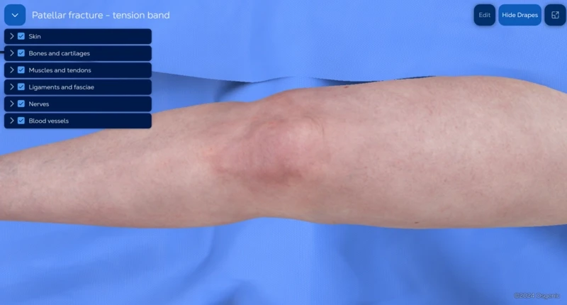 Patellar fracture fixation with tension band
