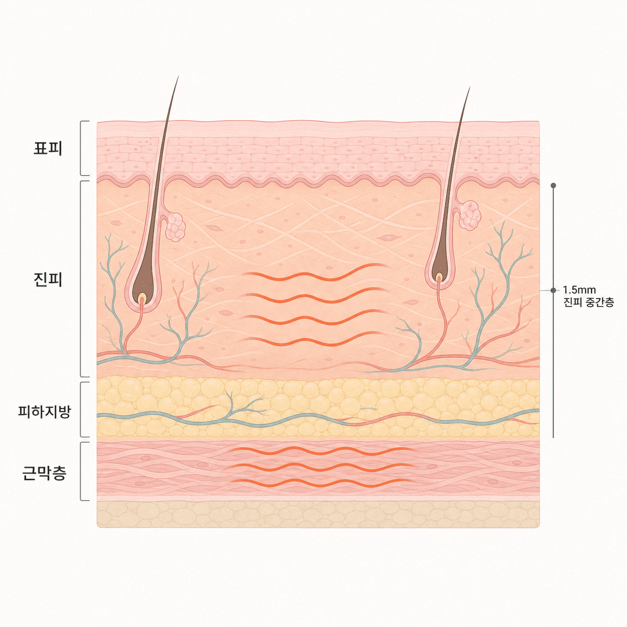 고주파 열이 닿는 피부층
