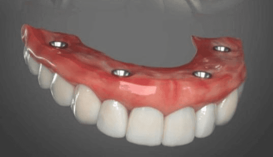 Full mouth implants AOX
