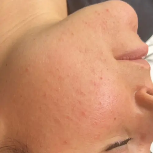 After cryotherapy facial at The Vancouver Aesthetician — acne and blackheads visibly clarified, pores tightened and skin noticeably calmer after cold globe treatment