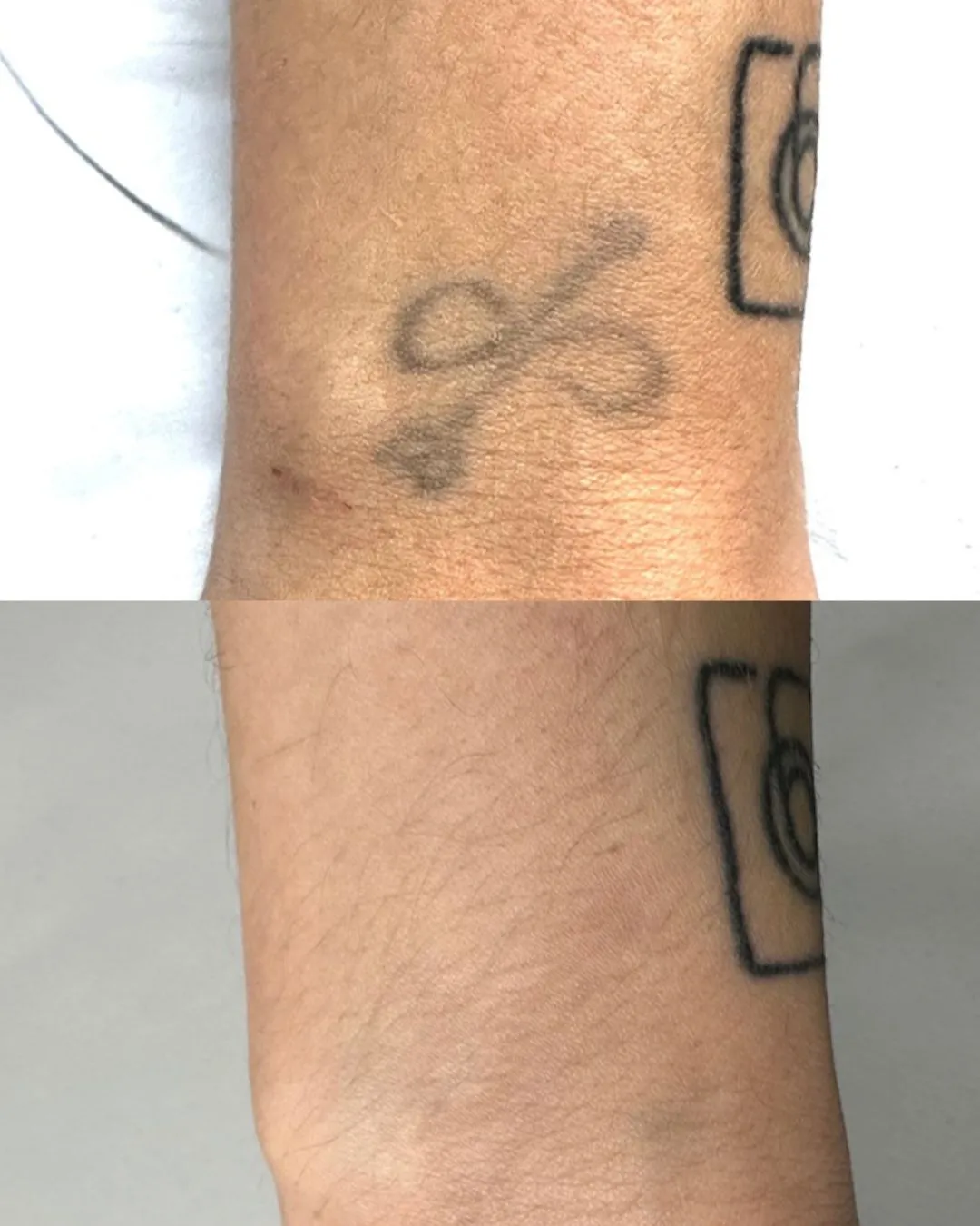 Corrección de tatuaje con láser en Móstoles