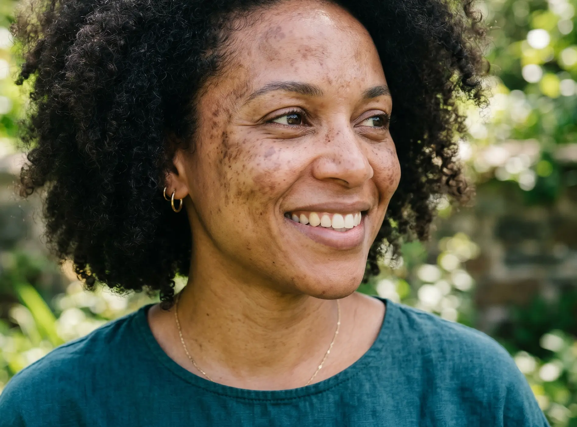 hyperpigmentation dark spots