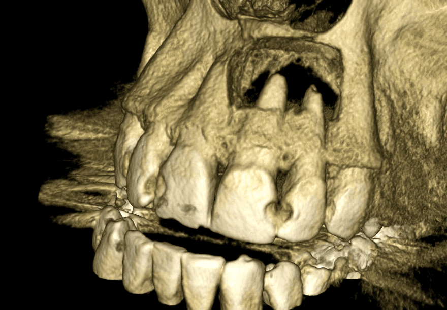 CBCT s kostnou cystou nad devitálnym zubom
