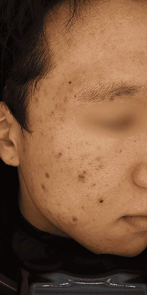 Acne - Before