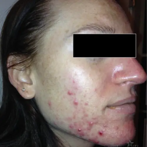 Before LED light therapy at The Vancouver Aesthetician — active acne breakouts and blackheads visible on skin