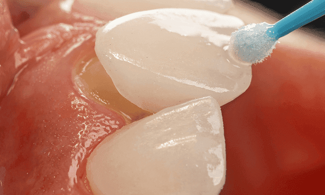 Tannlege med hansker holder skallfasetter som brukes til å forbedre tennenes utseende.