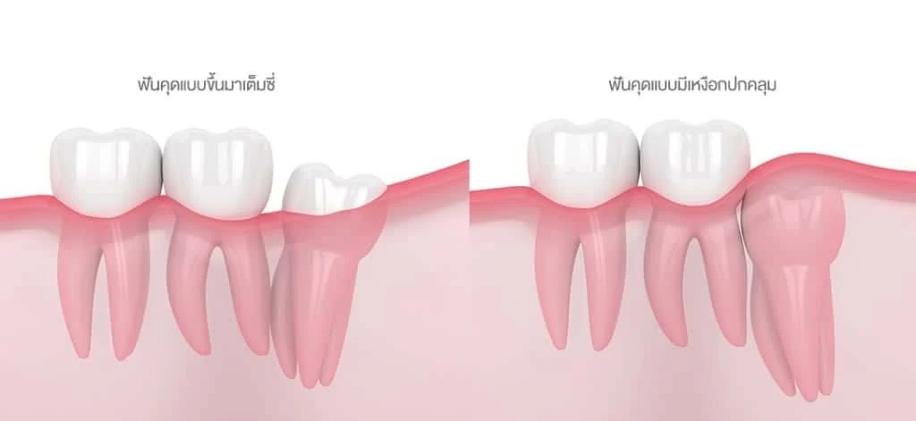 Wisdom teeth assessment and removal at COSDENT Smile Design
