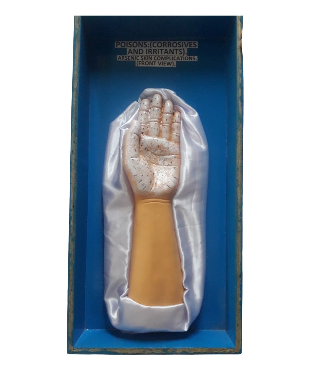 Arsenic Skin Complications (Front View)