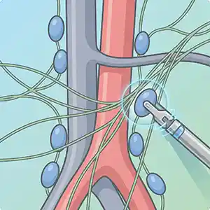 टेस्टिकुलर Cancer Icon इमेज में retroperitoneal lymph node basin को स्टाइलाइज्ड दिखाया गया है। एक robotic instrument critical ejaculatory nerves को बचाते हुए टेस्टिकुलर cancer के staging के लिए Retroperitoneal Lymph Node Dissection (RPLND) करता है।