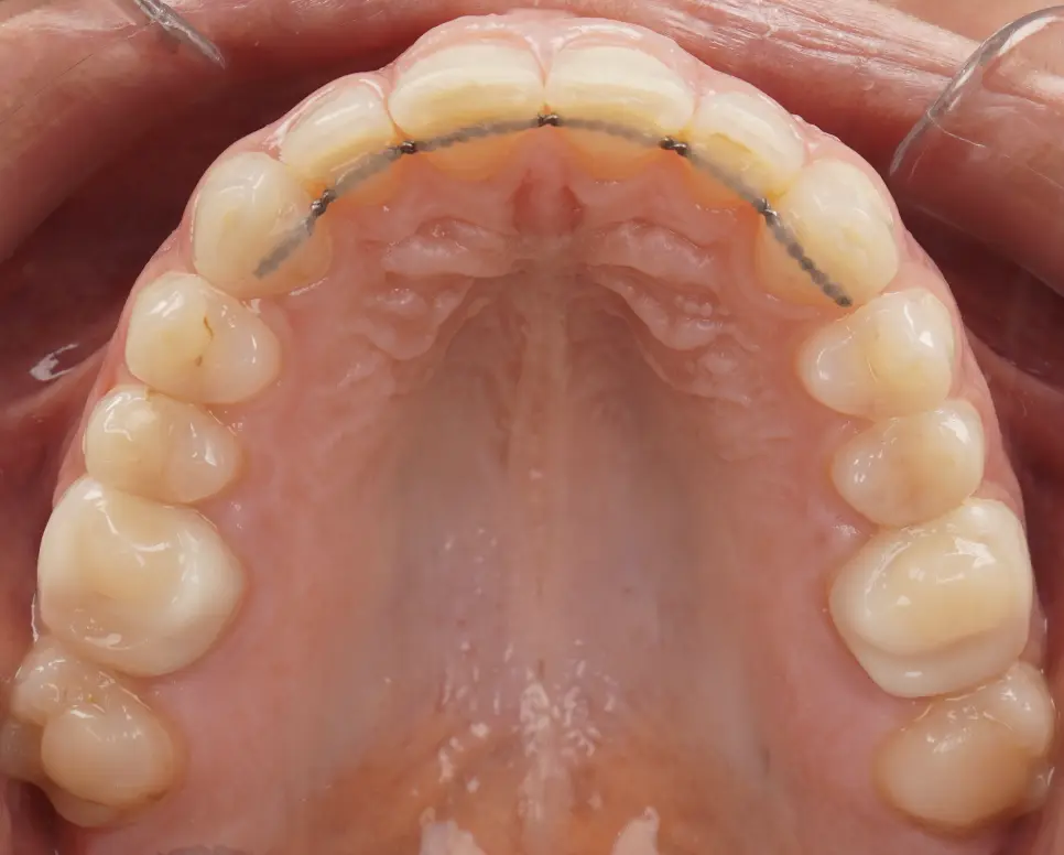 After ortho treatment
