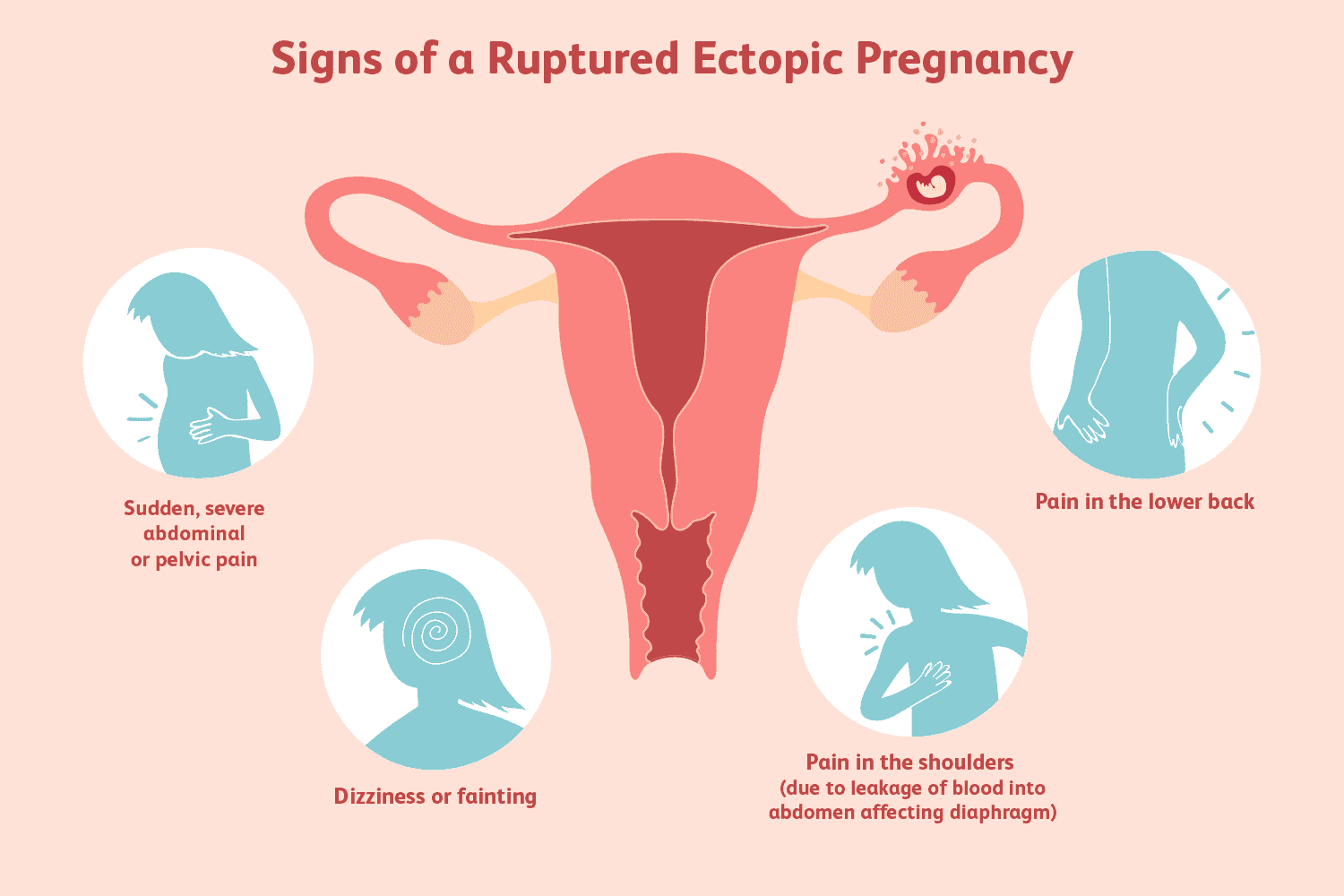 Ruptured Ectopic Pregnancy: Signs, Symptoms, Treatment
