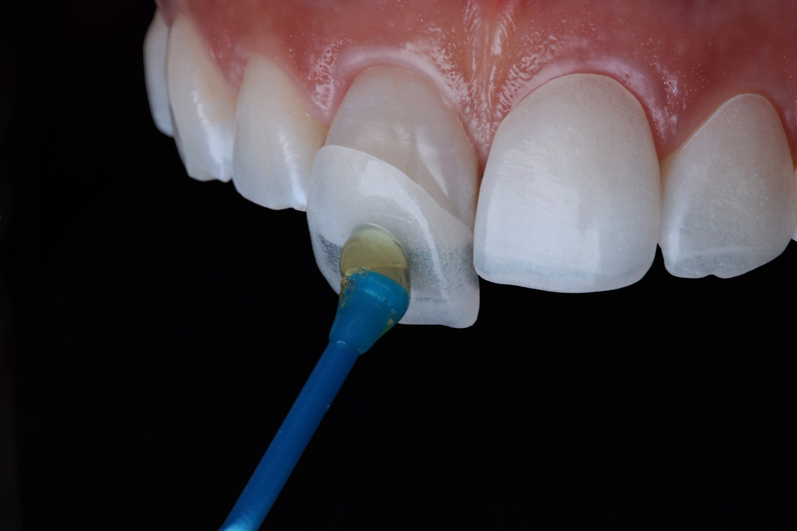 veneers