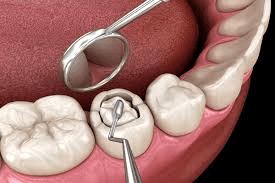 teeth filings