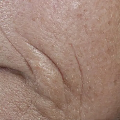 Before antioxidant treatment at The Vancouver Aesthetician — visible wrinkles around the mouth and noticeable periorbital smile lines on skin