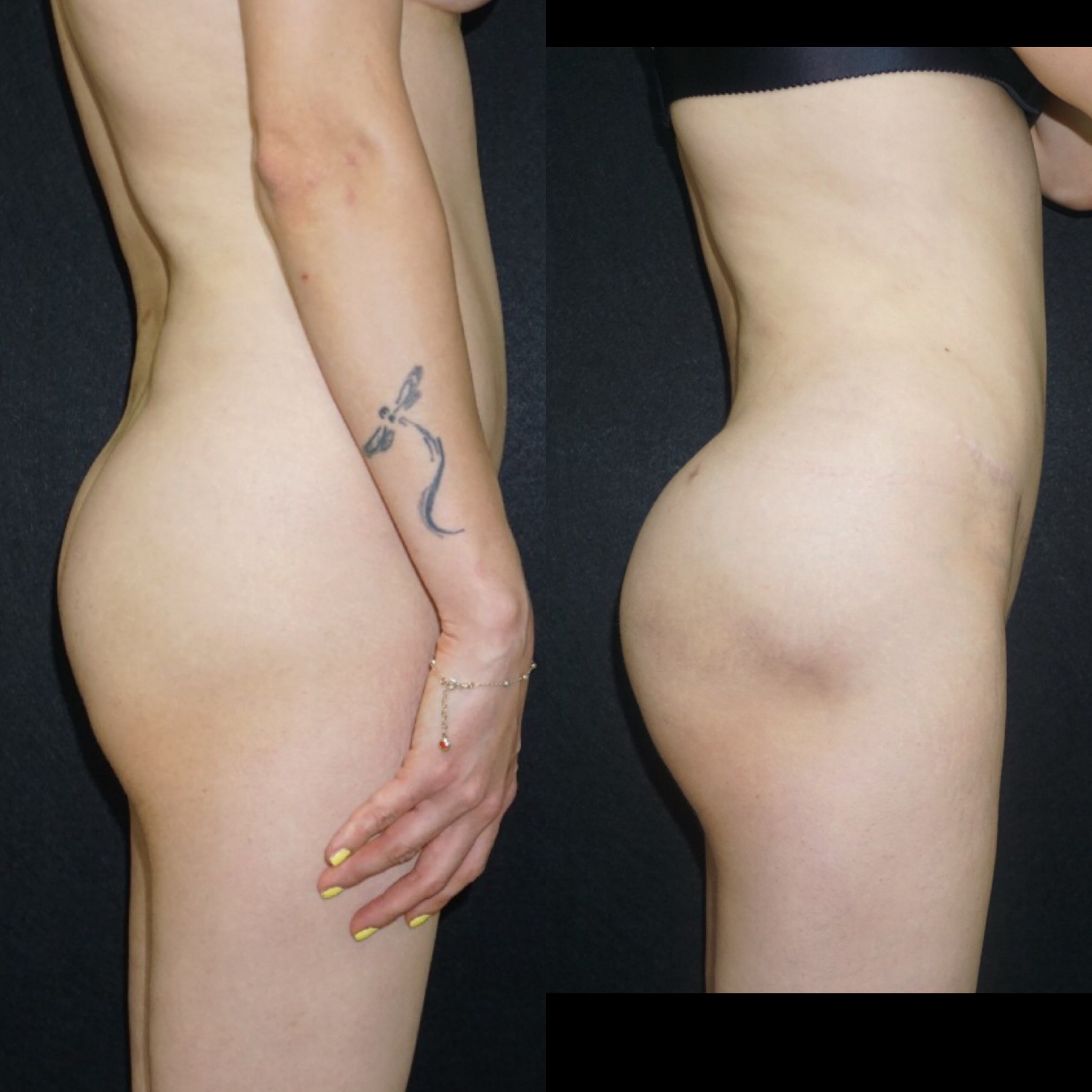 BBL before after vaser liposuction laser skin tightening and fat injection to buttocks