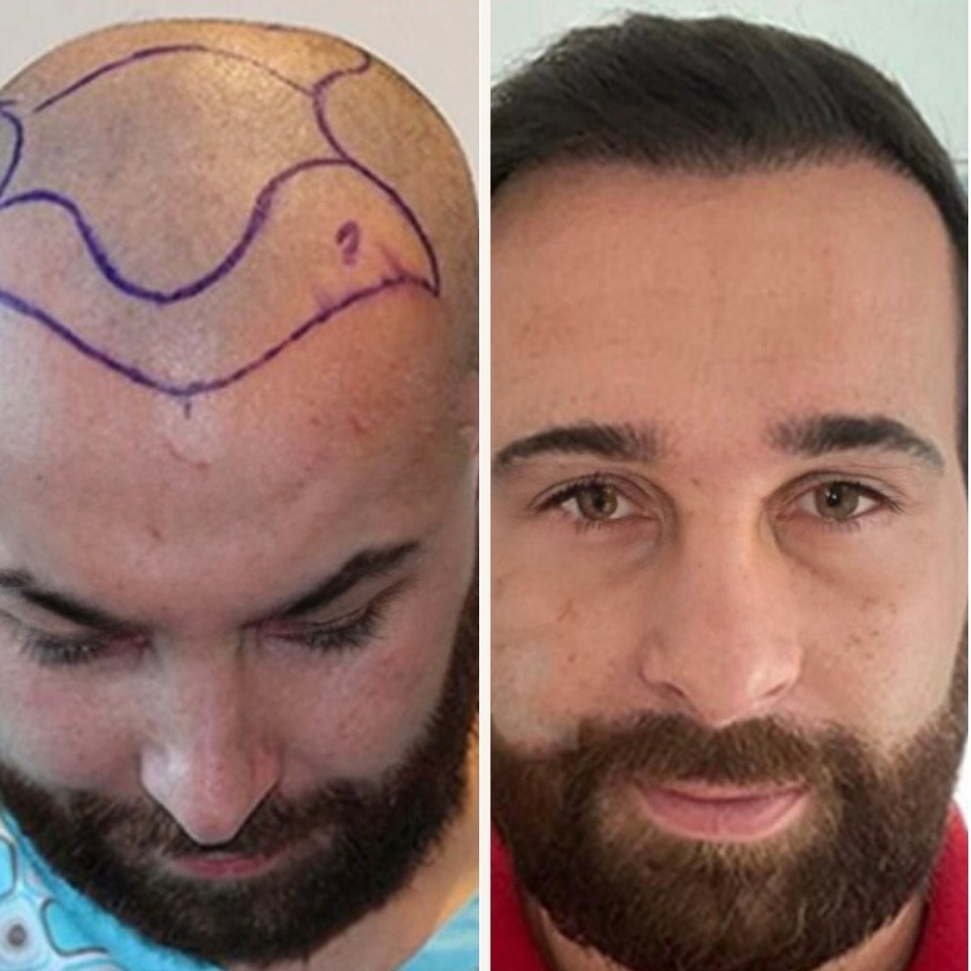 hair transplant