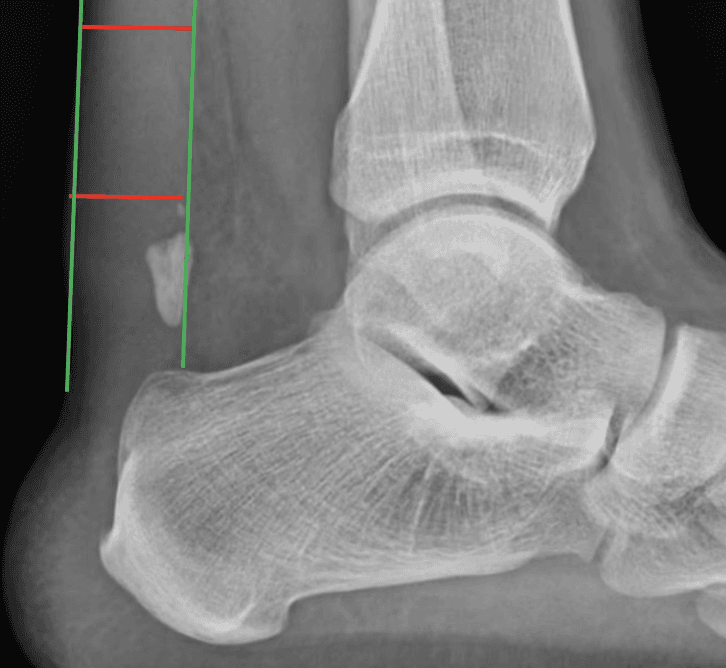 x-ray of calcific tendonitis