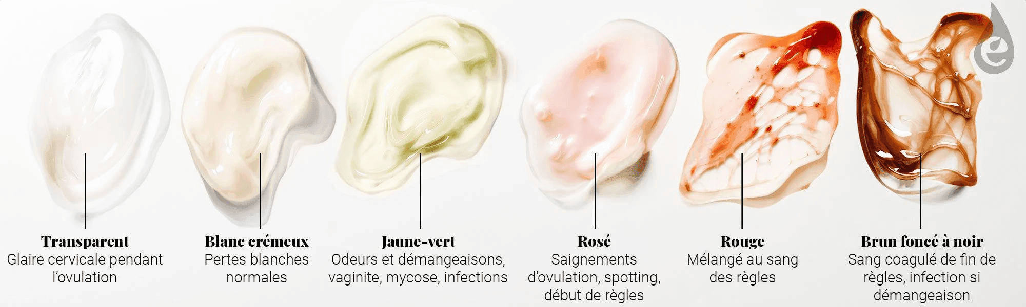 Types de pertes vaginales chez la femme