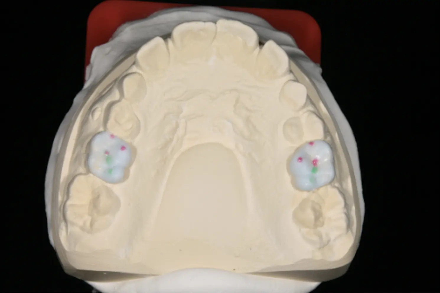 Wax-up-Entwurf der zukünftigen Onlays mit einem speziellen Mechanismus, der den Unterkiefer in eine  grundlegend bessere physiologische Position bringt. Dieser Ansatz entlastet die Kiefergelenke (TMJs)  und fördert ein gesundes Wachstum der Kiefer sowie der Gesichts- und Schädelknochen.