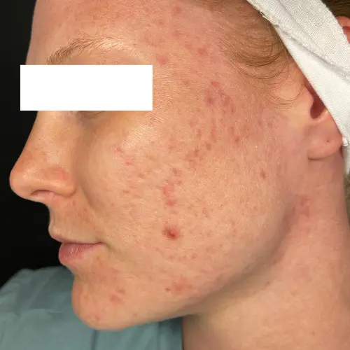 Before acne scar treatment at The Vancouver Aesthetician — severe pitted atrophic acne scarring and significant skin texture irregularity