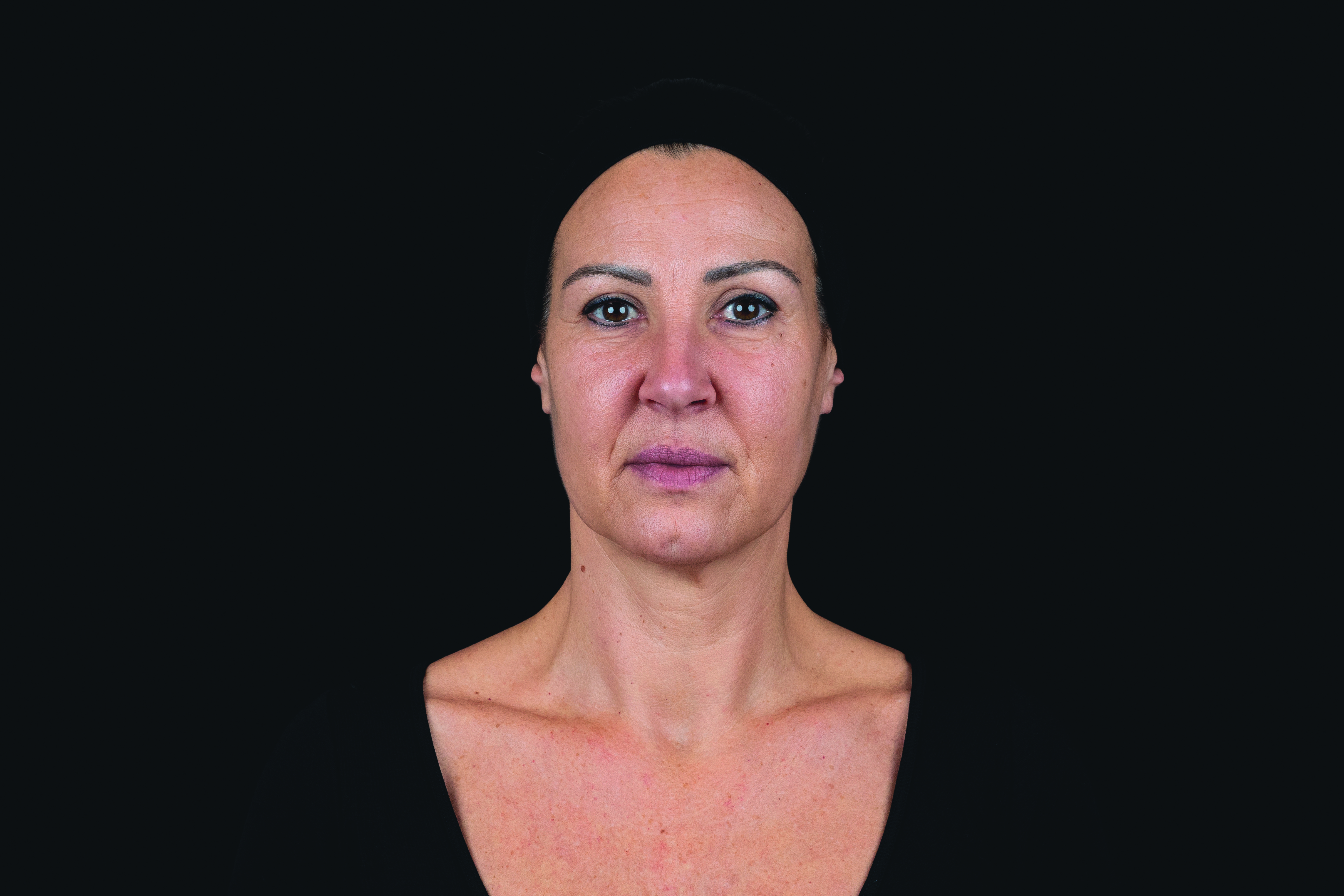 Female model before dermal filler treatment with Croma Saypha Volume Lidocaine