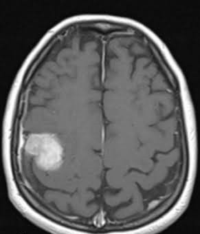 MRI scan of a brain displaying a Meningioma tumor highlighted for diagnosis.