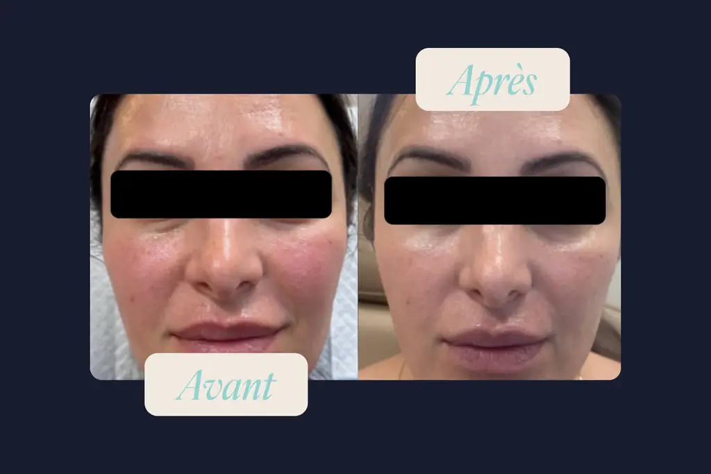 avant-après epilation laser visage moustache