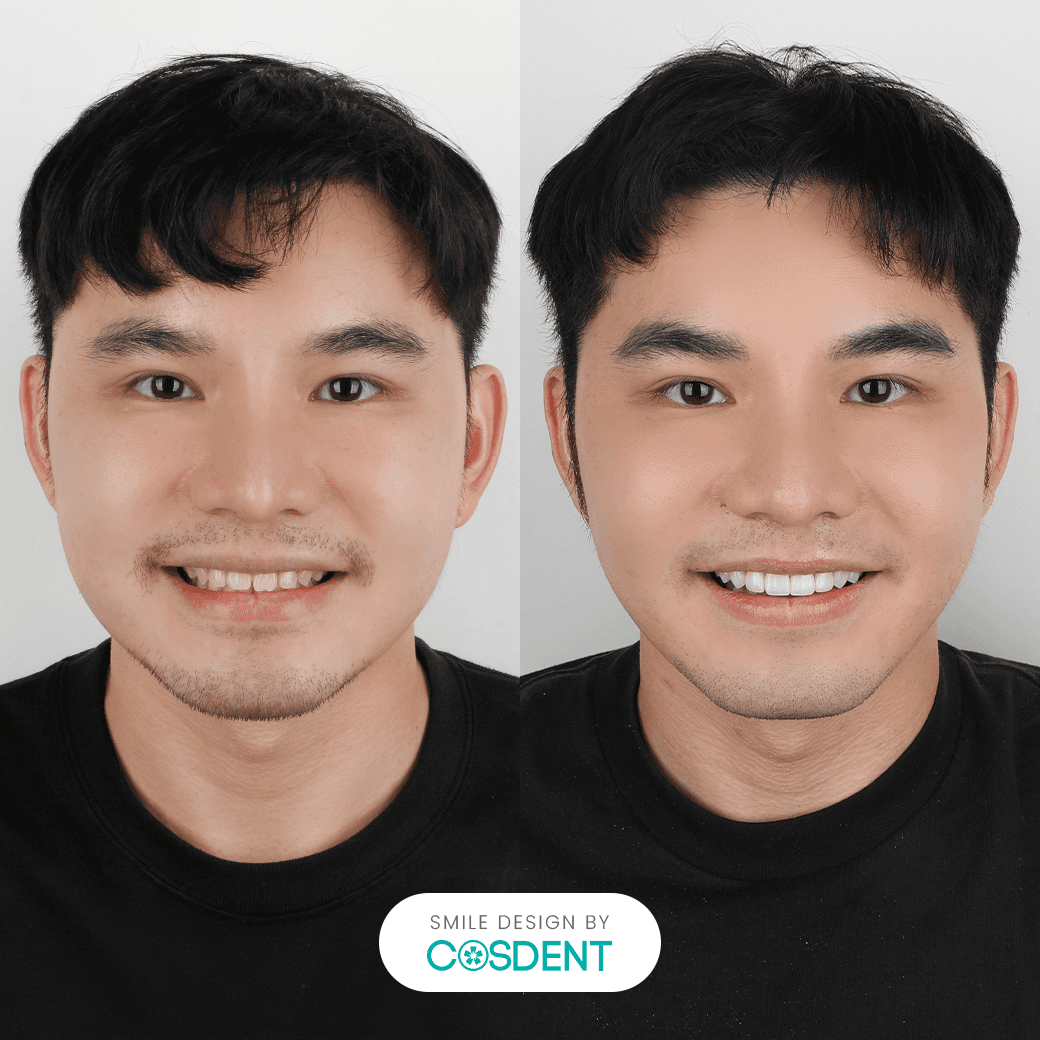 หน้าสามเหลี่ยมกลับหัว ยิ้มกว้าง 18 ซี่ after face line