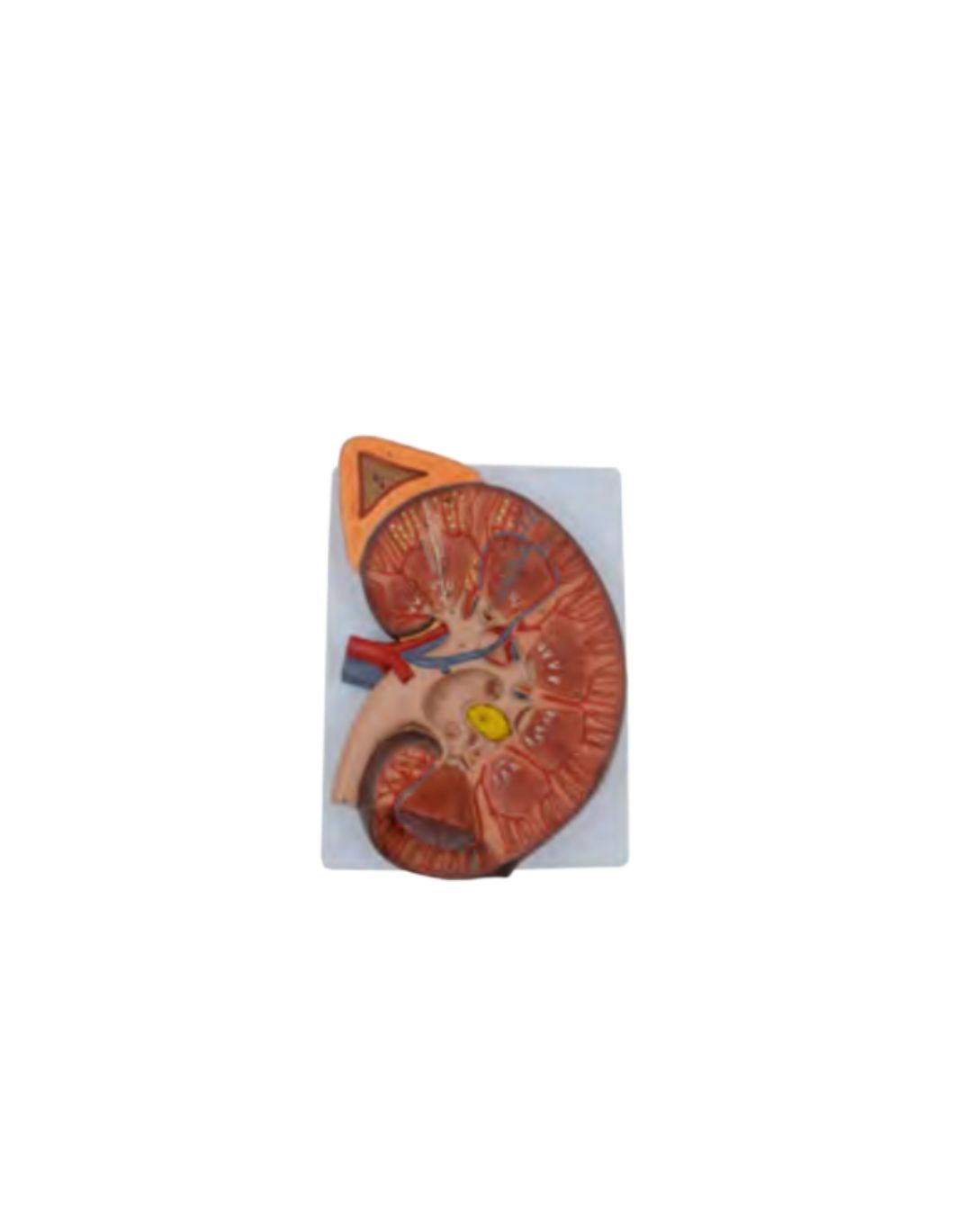 Enlarged Kidney