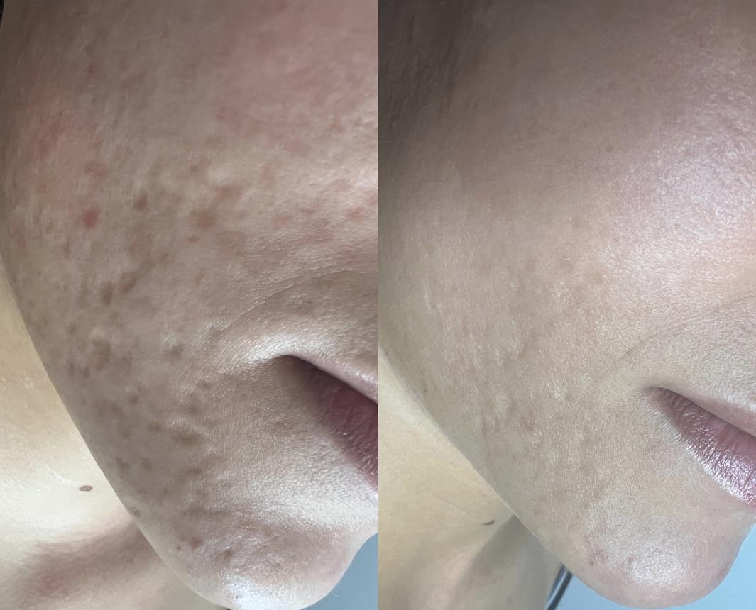 Laser frakcyjny Gdańsk | Garden Clinic