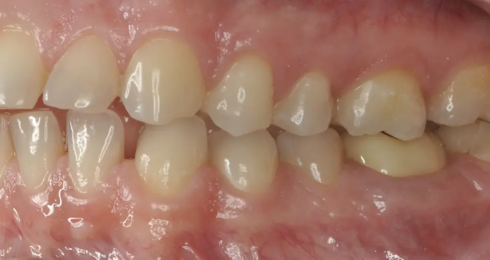 Before ortho treatment