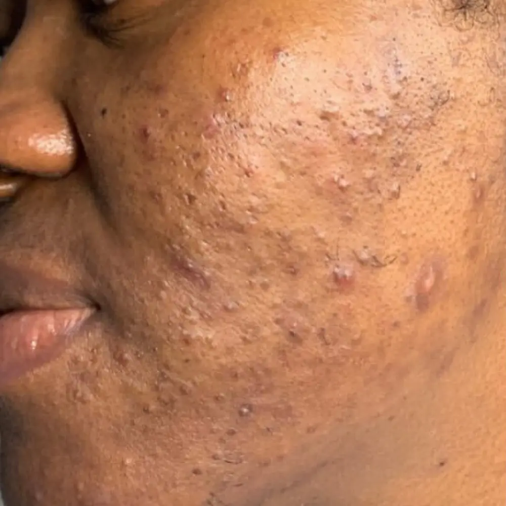 Before vitamin C enzyme facial at The Vancouver Aesthetician — visible acne and pigmentation on deep melanin-rich skin tone
