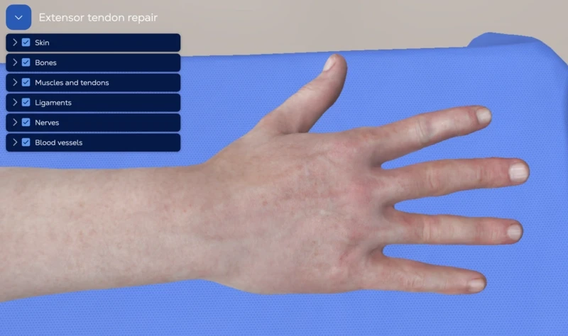 Extensor tendon repair in the hand area