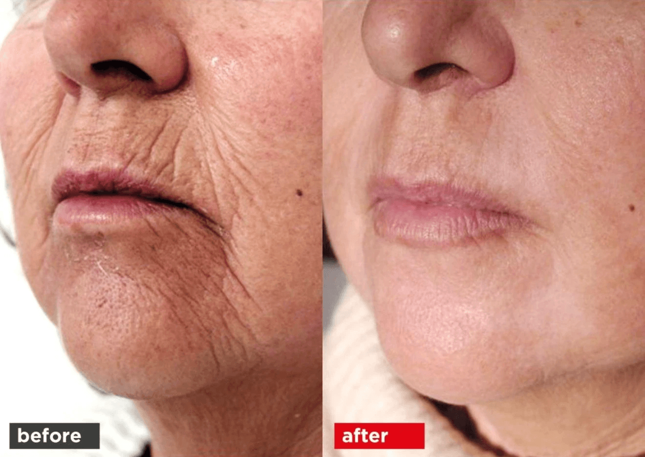 Fotona 4D mouth wrinkle before and after results.
