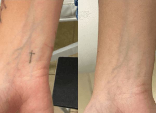 Imagem de antes e depois da remoção de tatuagem