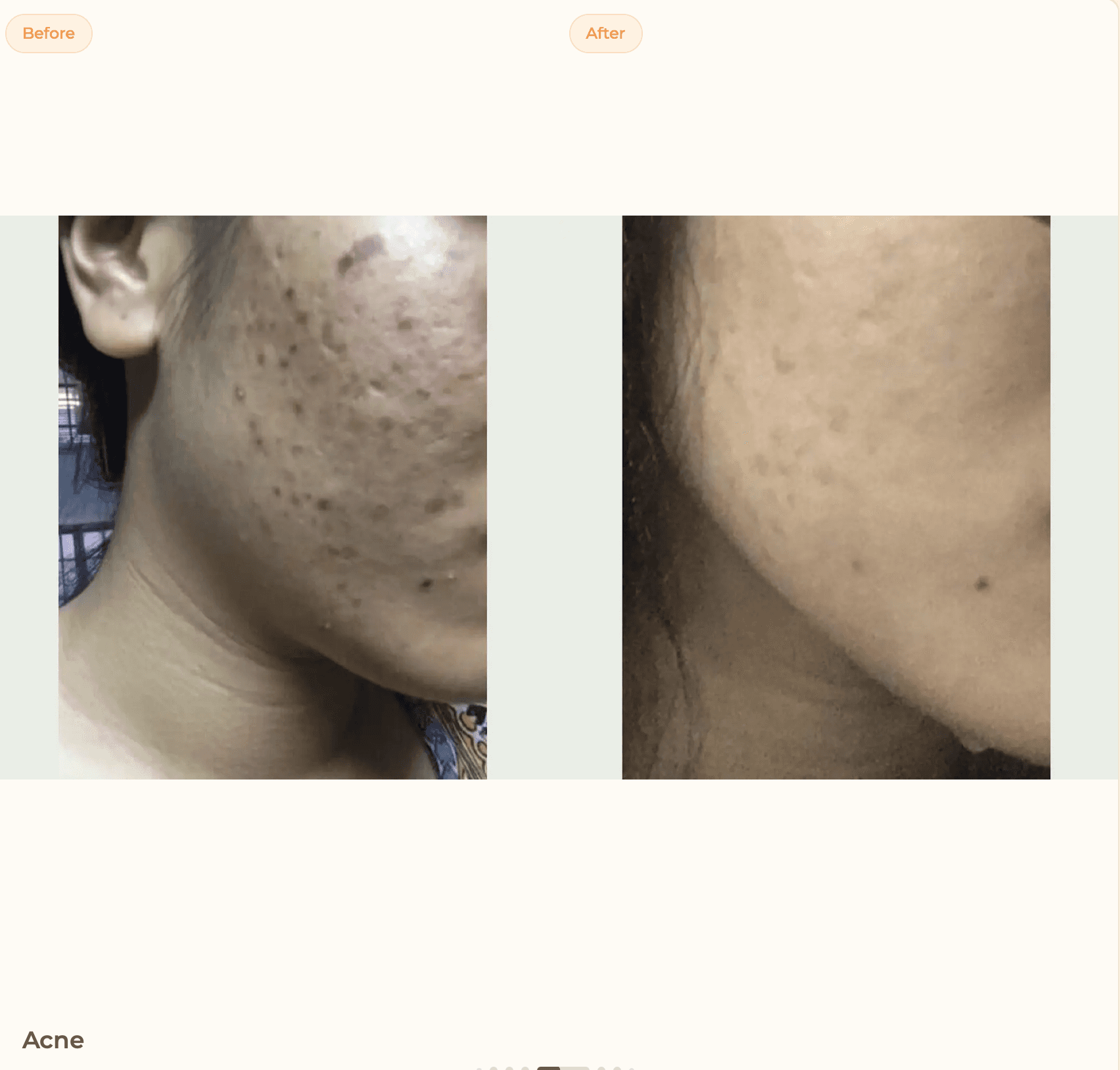 Microneedling · Acne: after treatment