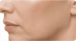 Acne scarring
