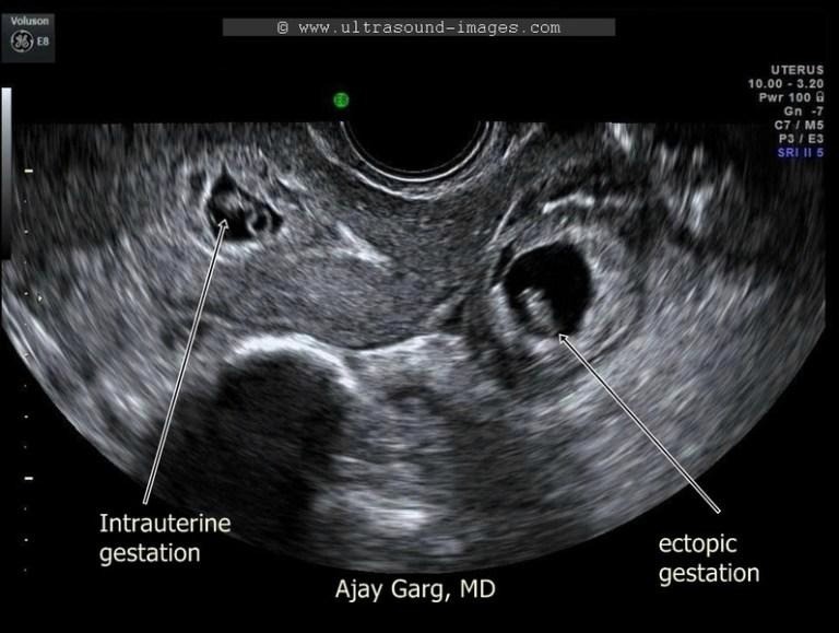 An ultrasound of a baby

AI-generated content may be incorrect.