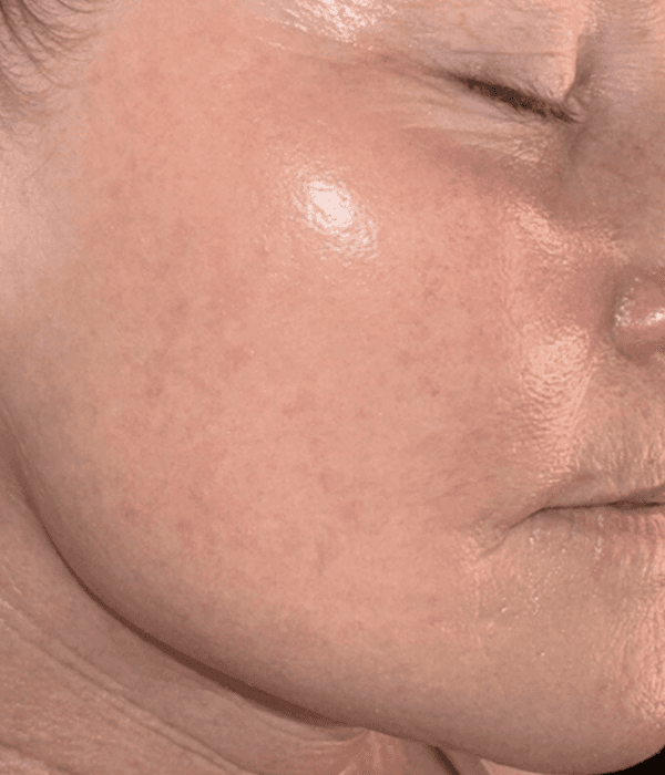 After Microneedling