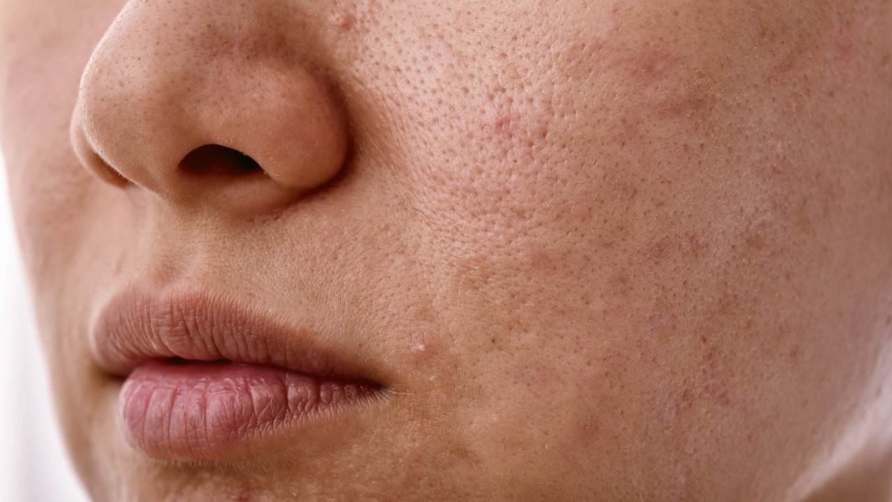 Close-up of facial skin with acne scars